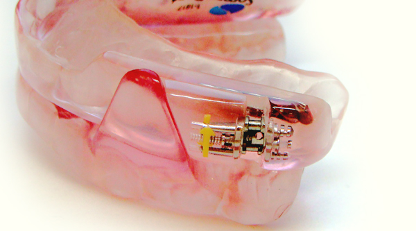 いびき治療・睡眠時無呼吸症候群のマウスピース