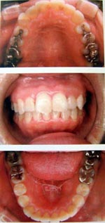 子供の顎を拡げる矯正装置・拡大矯正後・東京都港区麻布十番