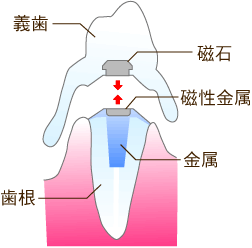 磁石の入れ歯の仕組み・東京都港区麻布十番の歯科医院